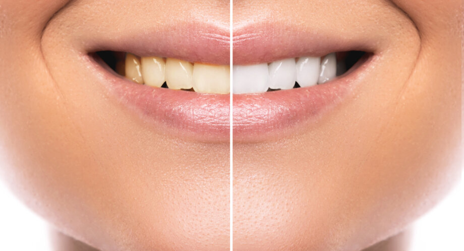 porównanie koloru zębów